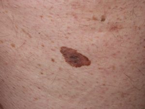 melanoma dr. Alessandro Testori Milano