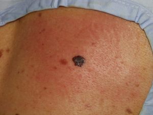 melanoma dorso