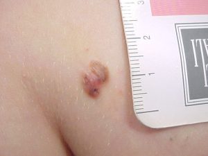melanoma pettorale