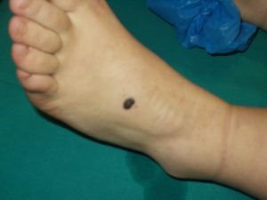 melanoma piede