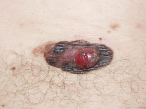 melanoma primitivo avanzato