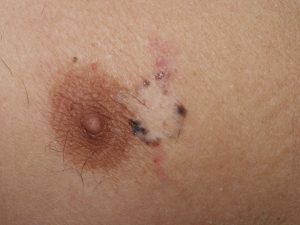 melanoma regredito