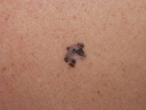 melanoma dr. Alessandro Testori Lombardia