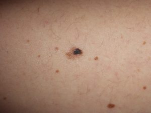 Melanoma pelle